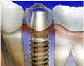 インプラント歯科